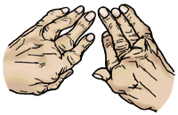 関節リウマチの手の変形